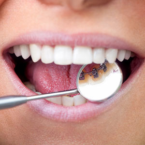 Lingual Braces Offer a Less Visible Alternative to Traditional Braces Lingual Braces Offer a Less Visible Alternative to Traditional Braces
