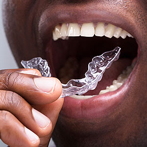 WearingaRetainerWillProtectYourNewSmileAfterBraces