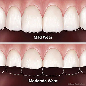 3ThingsYoucandotoSlowToothWear