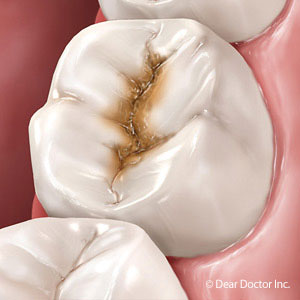Manage These Risk Factors to Reduce Your Risk of Tooth Decay Manage These Risk Factors to Reduce Your Risk of Tooth Decay