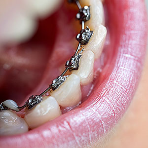 LingualBracesMightbeaBetterFitforYourActiveLifestyle