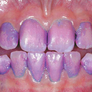 HowEffectiveisYourOralHygieneFindOutwithaPlaqueDisclosingAgent