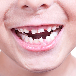 gap between first teeth