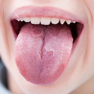 sore tongue and teeth marks