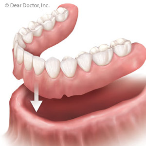 RemovableDenturesRemainaViableOptionforPeoplewithTotalToothLoss