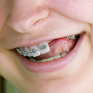 RemovingOneorMoreTeethCouldImproveOrthodonticOutcomes