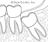 TheConsequencesofanImpactedWisdomTooth