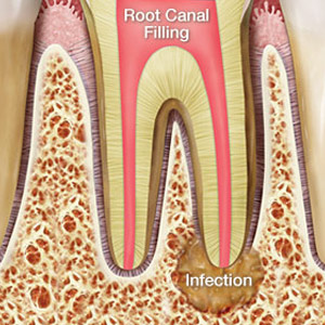 do teeth still hurt after root canal