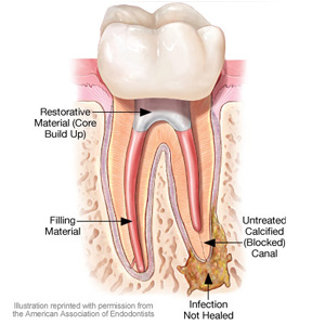ASecondRootCanalTreatmentMayHelpSaveanEndangeredTooth