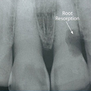 CatchRootResorptionEarlyforBestChancesofSavingYourTooth