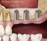EncouragingBoneGrowthforFutureImplantsThroughSinusSurgery