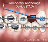 AnchorageDevicescanaddStabilityDuringOrthodonticTreatment