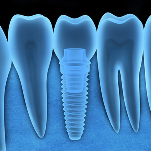 DentalImplantsBetterthanEverthankstoOngoingTechAdvances