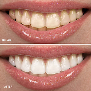 teeth whitening.