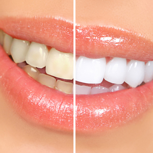 3QuestionsYouShouldAskbeforeUndergoingTeethWhitening