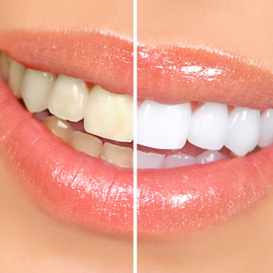 WeighingtheProsandConsofTeethWhitening