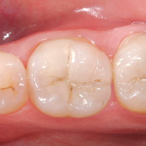 ItsanArtDeterminingToothColorinCompositeResinRestorations