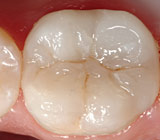 Tooth-ColoredFillings-DoTheyReallyLookNatural
