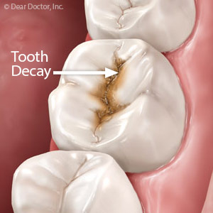 AlthoughaChallengeChronicallyIllChildrenNeedToothDecayPrevention