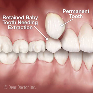 dental implants fix crooked teeth