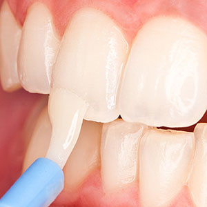 TopicalFluorideCouldFurtherLowerToothDecayRiskinChildren