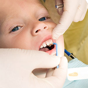TopicalFluorideOffersaProtectiveBoosttoChildrenatHighRiskforDecay