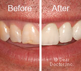 ArePorcelainVeneersRightForYou
