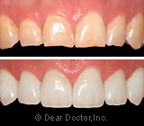 veneers.