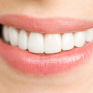 WhatYouShouldKnowAboutVeneersforTeenagers