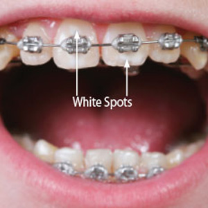 Stop White Spots Before They Appear While Wearing Braces Stop White Spots Before They Appear While Wearing Braces