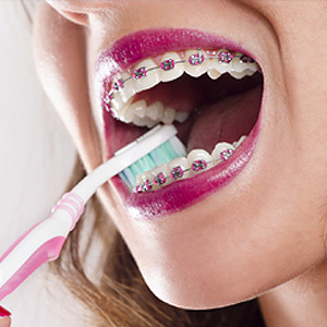 BeVigilantwithDentalCareWhileWearingBraces