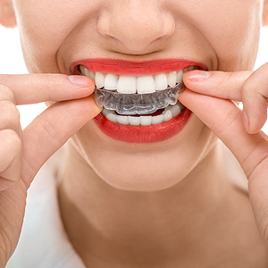 ARetainerHelpsYouKeepYourNewSmileAfterBraces
