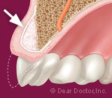 Bone Grafting.