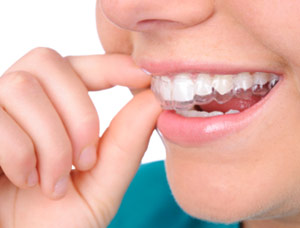 invisalign.
