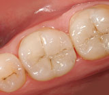 Tooth Colored Fillings.