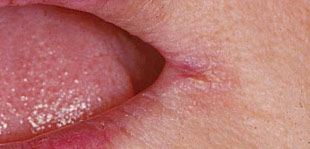 Corner Of Mouth Irritation 3