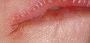 Mouth sores and Skin rash: Common Related Medical Conditions