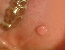 Black Lump In Mouth 39