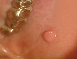 Lump In Mouth Lip 95