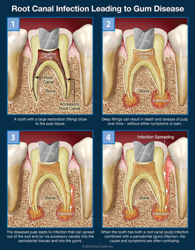 my upper back teeth hurt