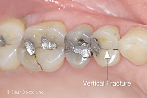 Vertical Hairline Crack Tooth