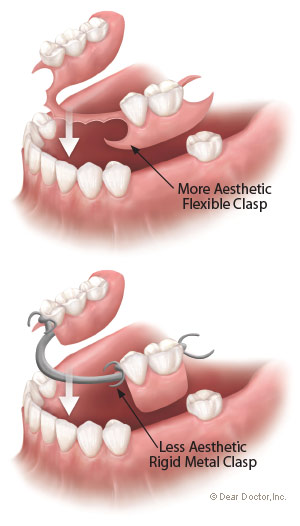 Types of flexible partial dentures.