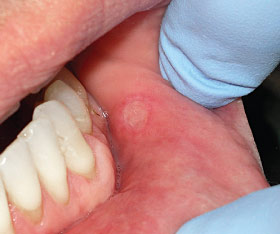 Mouth blister - RightDiagnosis.com
