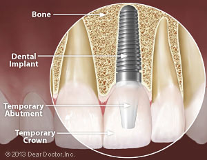 What are the main steps of a front tooth extraction procedure?