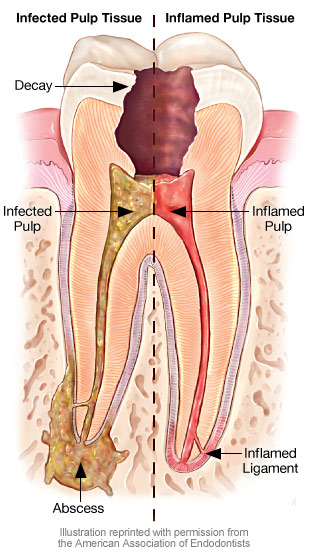 Can sinus infection cause severe pain in lower teeth 