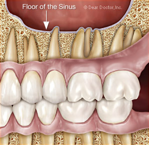 aching upper jaw teeth