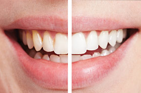 Tooth Whitening Safety Tips - Are Bleaching Products Safe?