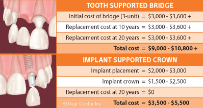 Dental implant options.