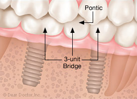 3-unit bridge with pontic.