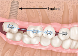 Dental implant for anchorage.
